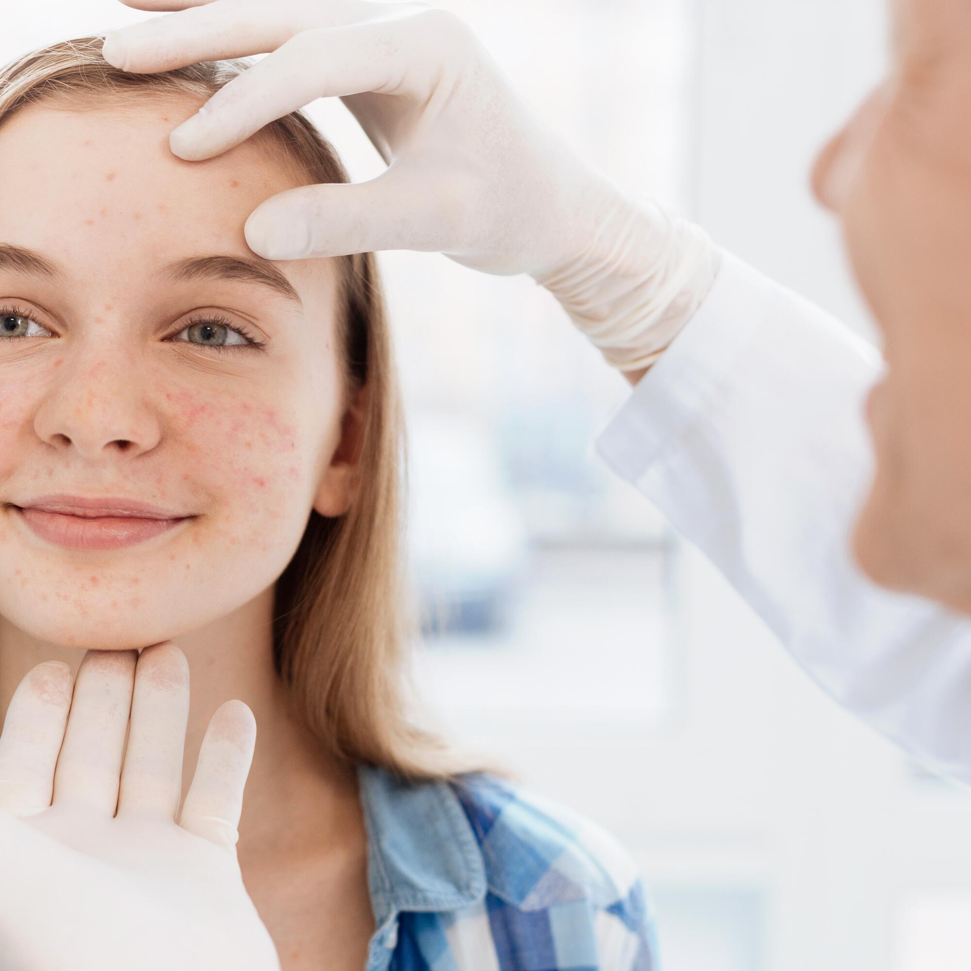 Ddermatologue pour l’acné chez l’adolescent